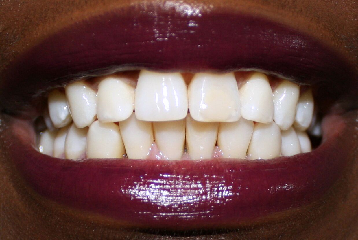Smile Brilliant Review after , teeth whitening, Toronto beauty blogger 
