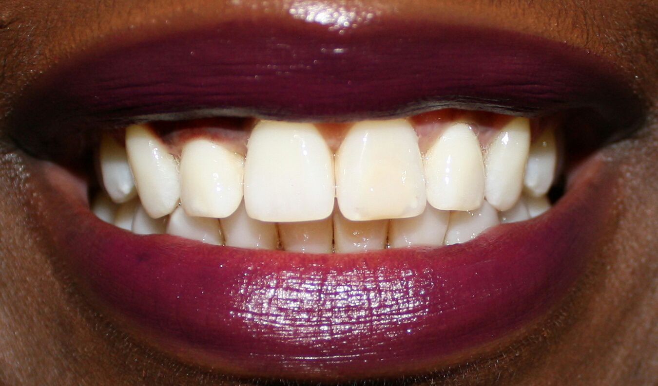 Smile Brilliant Review before , teeth whitening, Toronto beauty blogger 